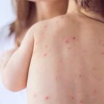 La Secretaría de Salud confirma nuevos casos de sarampión, sumando 33 en Nuevo León durante 2026. ¿Qué implica esto?