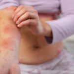 Nuevo León enfrenta un aumento significativo de casos de sarampión, mientras continúan las campañas de vacunación en México.