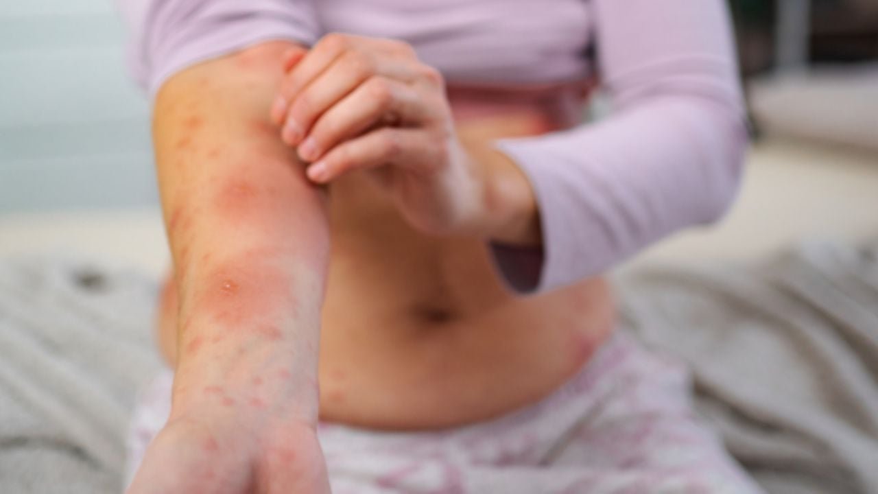 Nuevo León enfrenta un aumento significativo de casos de sarampión, mientras continúan las campañas de vacunación en México.