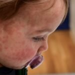 Los funcionarios del PAN solicitan claridad sobre el incremento de casos de sarampión en Nuevo León. La salud pública está en juego.