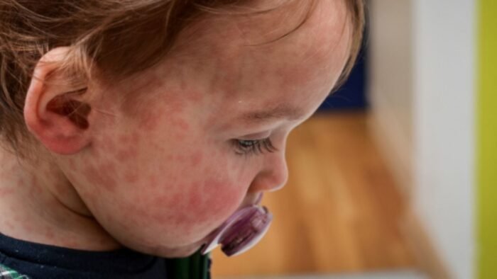 Los funcionarios del PAN solicitan claridad sobre el incremento de casos de sarampión en Nuevo León. La salud pública está en juego.